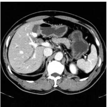 Fig. 1. Computed tomographic scan shows mildly dilated intrahep- intrahep-atic bile duct and many small stones in the gallbladder