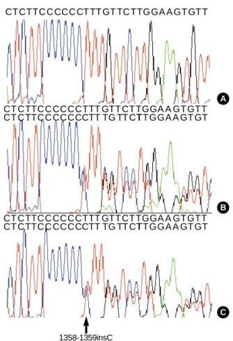 Fig. 1. The sequence analysis of the thyroid hormone receptor- receptor-(TH- RB) gene in the patient (B) and her son (C) shows an  inser-tion of a C at posiinser-tion 1358/1359 in exon 10