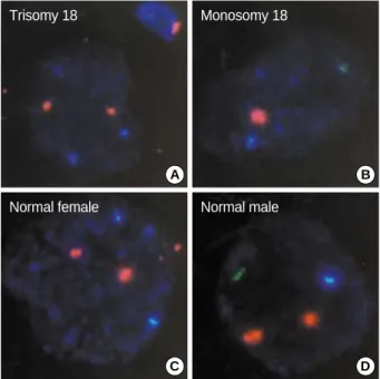 Fig. 3. Results of the fluorescence in situ hybridization (FISH) anal- anal-ysis on the embryos diagnosed to be normal by PCR in the PGD for OTC deficiency