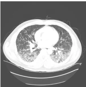 Fig. 2. HRCT  scan  on  hospital  day  #2  shows  multiple  less  than  1cm  sized  nodules  and  consolidation  in  both  lung  fields.
