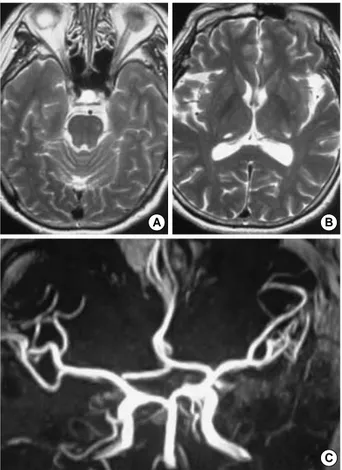 Fig. 2. Thoracic sagittal magnetic resonance imaging shows a large elliptical epidural mass that is iso- to hypersignal on T1 (A) and cere- cere-brospinal fluid-like hypersignal on T2-weighted images (B)
