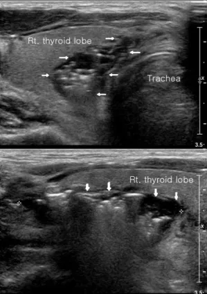 Fig. 2. The  CT  of  the  neck  showing  air  and  fluid  collections  between  the  thyroid  and  the  trachea  (arrows  pointing  towards  the  lesion).