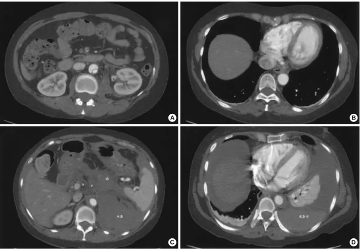 Fig. 2. Computed tomography (CT) of the thoracoabdominal aorta. (A, B) Initial CT demonstrated aortic dissection, which involved the ab- ab-dominal aorta and spared the thoracic aorta