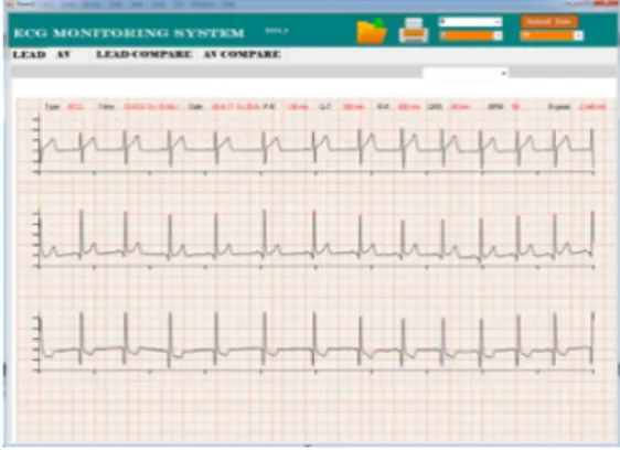 Fig. 12. ECG data output of Windows viewer screen
