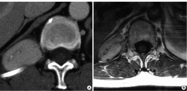 Fig. 2. (A) Contrast-enhance abdominal CT revealing a solitary paraspinal soft tissue mass with homogeneous attenuation in the posterior aspect of the right hemithorax