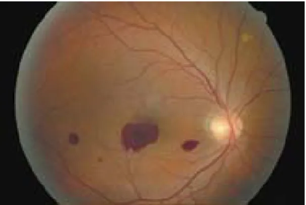 Fig. 2. Fluorescein  angiography  of  the  right  eye  showing  blocking  of  background  choroidal  fluorescence  by  the  hemorrhages  without  any  vascular  leakage  in  early  phase  and  late  phase.