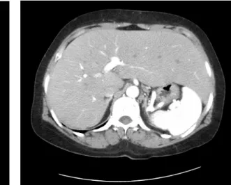 Fig. 2. CT  scan  of  diffuse  hepatomegaly. 