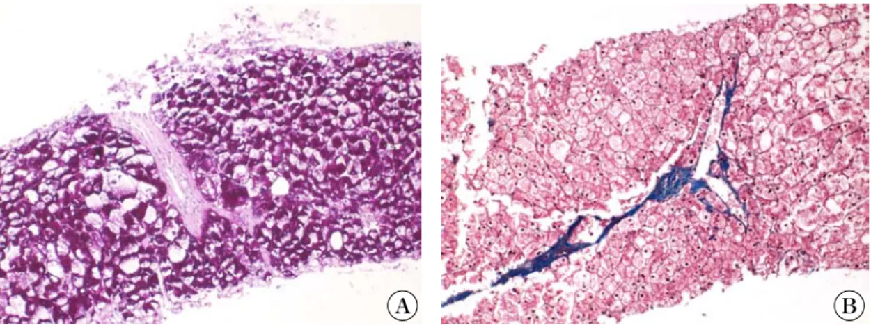 Fig. 4. In  skeletal  muscle  biopsy,  (A)  small  to  large-sized  vacuolar  changes  and  glycogen  accumulation  are  shown  (PAS,  *100)