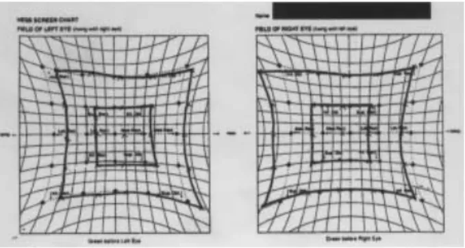 Fig. 2. (A) Unsuccessful abduction of the left eye during attempt- attempt-ed left gaze
