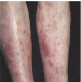 Fig. 1. Multiple erythematous to brownish nodules are shown on both lower legs. 
