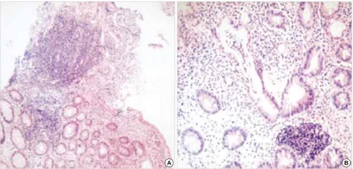 Fig. 4. Microscopic examination of the perineal lesion revealed chronic ulcer with acute and chronic inflammatory cell infiltration and in- in-creased small blood vessels (A: H&amp;E stain, ×100; B: H&amp;E stain, ×400).