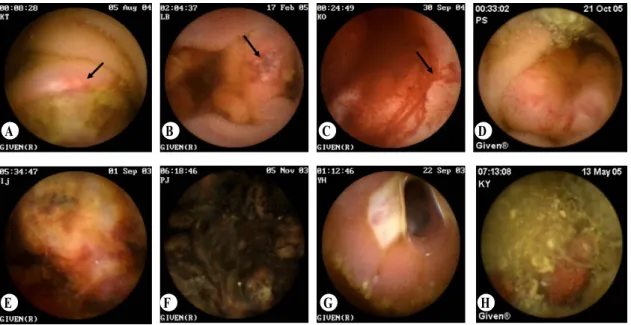 Fig.  1.  Capsule  endoscopic  findings. 