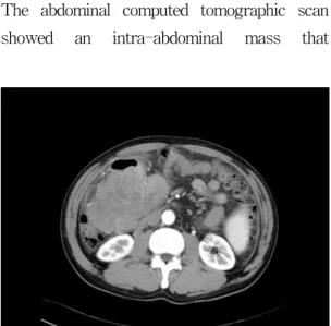 Fig. 1. The  abdominal  contrast-enhanced  computed  tomographic  scan  shows  a  large  tumor  in  the  right  abdominal  cavity
