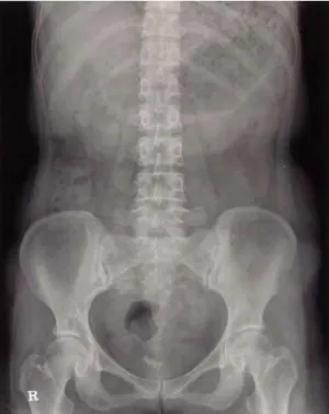 Fig. 1. KUB  shows  a  2.5x2.2  cm  sized,  irregular  shaped,  calcification  in  the  region  of  the  urinary  bladder.