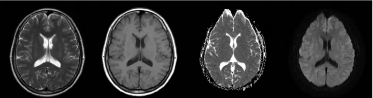 Fig. 1. Brain  MRI  shows  no  acute  cerebral  infarction.