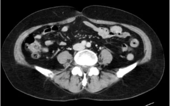 Fig. 2C. Gross  specimen  shows  a  mass  with  exophytic  gross  pattern.