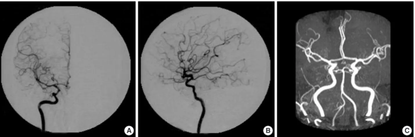 Table 1. Reported cases of mechanical compression of major vessels following pituitary apoplexy