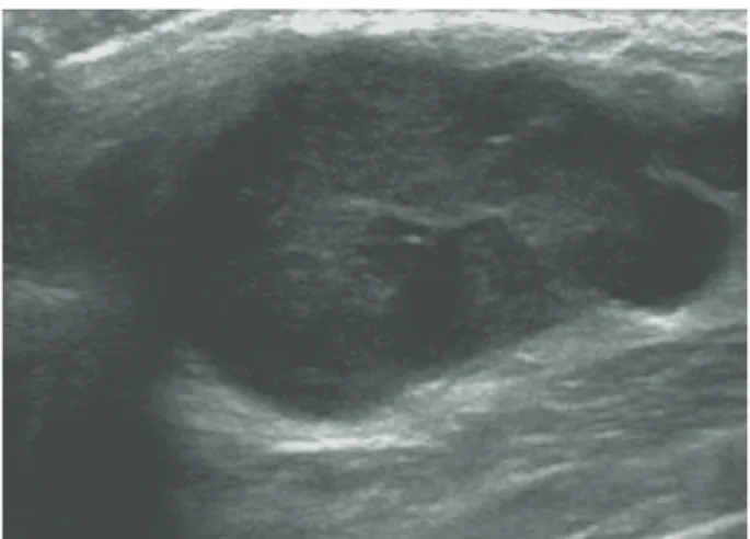 Fig. 1. Mammography showed a relatively well-demarcated,  lob-ular shaped mass in the mid-outer portion of the left breast.