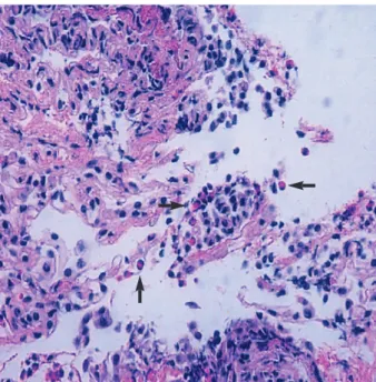 Fig. 3. Transbronchial lung biopsy showing marked infiltration of eosinophils and interstitial thickening