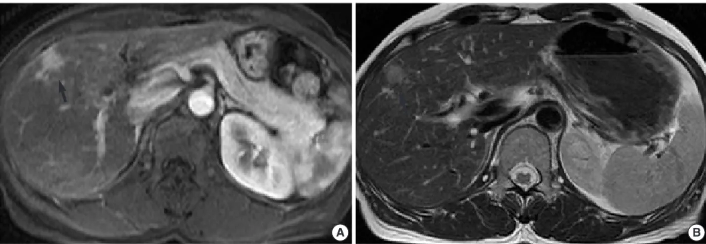 Fig. 1. (A) The respiratory-triggered T2-weighted turbo spin-echo MR imaging shows a small mass with intermediate high signal intensity (arrow) in liver segment 5