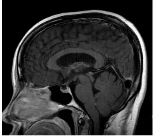 Fig. 6. Brain  MRI  :  Previous  noted  enhancement  of  thickening  pituitary  stalk  was  not  seen.