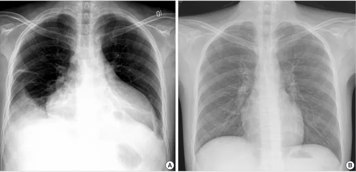 Fig. 1. Posteroanterior chest radiographs reveal a marked cardiomegaly with right pleural effusion before the treatment (A) and a normal- normal-ized heart after the deferoxamine therapy (B).