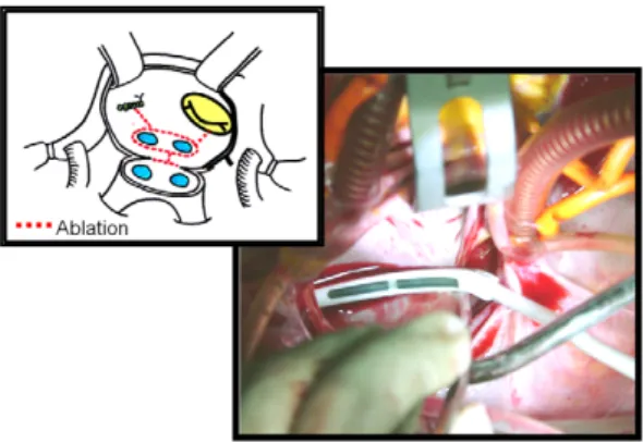 Fig. 3. Left  atrial  procedure  using  microwave  (AFX,  FLEX4).