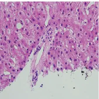 Fig. 1. Needle biopsy of the liver. The GVHD here is affecting the liver and marked by bile duct damage (hematoxylin and eosin stain, ×400).