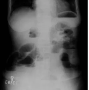Fig 1. Simple  Abdomen  shows  small  bowel  dilatation  and  multiple  air  fluid  levels.