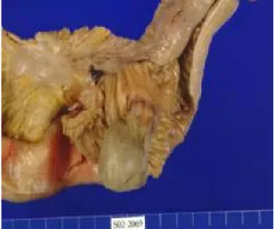 Fig 2. Contrast  enhanced  abdominal  CT  shows  fluid  filled  distended  small  bowel  loops  and  target  lesion  representing  intussusception  (white  arrow).
