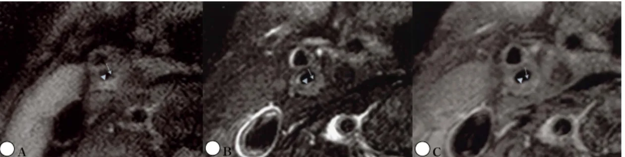 Fig. 3. Intraplaque  hemorrhage  of  left  proximal  internal  carotid  artery.  Intraplaque  recent  hemorrhage  (blanked  arrow)  indentified  by  hyperintensity  in  T1-(A)  and  proton  density  (B)  is  noted