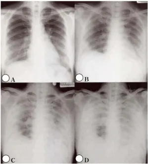 Fig.  1.  Serial  simple  chest  X-rays  (patient  1). 