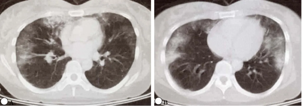Fig. 4. Chest  CT  scan  was  taken  4  days  after  silicon  injection(patient  2).  Multifocal  subpleural  consolidations  at  both  upper,  middle,  and  lower  lobes.(A,  B)  The  distribution  of  consolidations  also  reveal  non-dependent  portion.