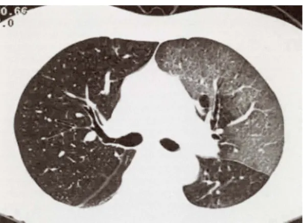 Fig. 6. Perfusion(A)  and  ventilation(B)  lung  scan  99mTc-MAA  was  taken  6  days  after  silicon  injection  (patient  4)