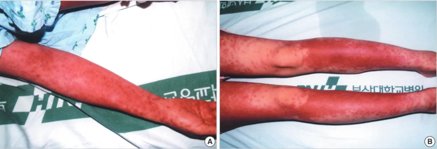 Fig. 1. Diffuse erythema on the patient’s right arm (A) and both legs (B).