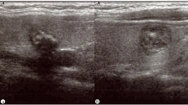 Fig.  1.  Two  nodules  at  both  thyroid  glands  in  56  year  old  female.  Left  side  nodule  (A)  shows  irregular  shape,  but  right  one  (B)  shows  round.