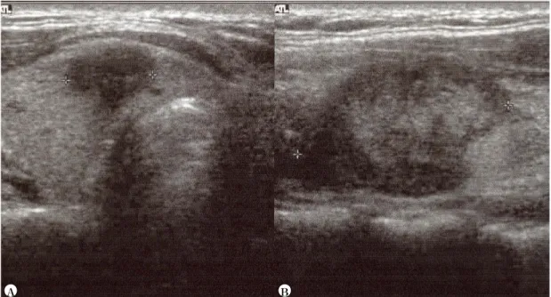Fig.  4.  Two  patients  with  nodules  with  calcification.  Microcalcification  (A)  and  dense  calcification  (B)  are  well  demonstrated.