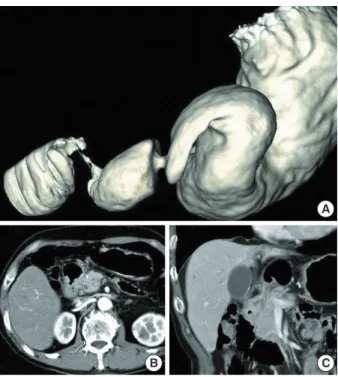 Fig. 2. Abdominal computed tomography: (A) obstruction finding due to circumference of the duodenal mass (B) lymph node  en-largement circumference of the duodenal mass (C) pancreatic invasion with fat tissue loss between the duodenal mass and  pan-creatic