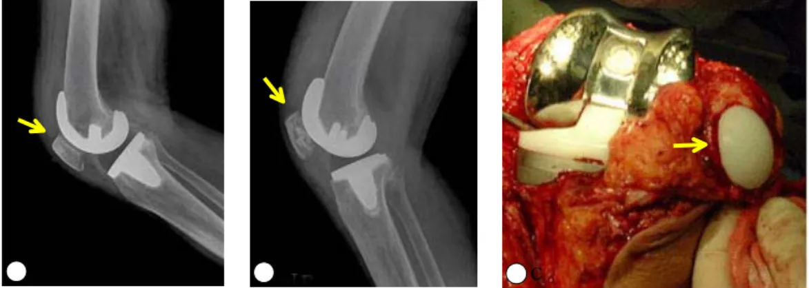 Fig.  2.  Total  knee  replacement  with  or  without  patellar  resurfacing.  A:  Patellar  preserving  type  B: 