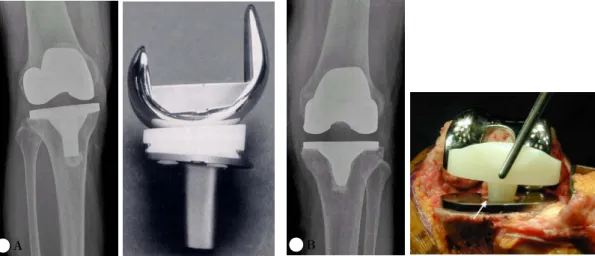 Fig.  3.  Total  knee  replacement  related  to  polyethylene  movement.  A:  Fixed  polyethylene  type  B: 