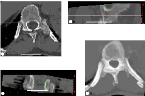 Fig. 2. Measurement  technique  for  height  (H)  and  width  (W)  of  pedicle.  Many  of  the  pedicles  show  teardrop  shape.