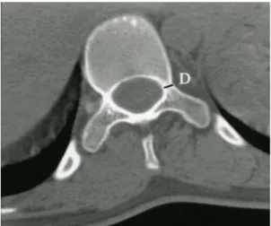 Fig. 3. Transverse  pedicle  diameter(D)  was  measured  at  the  mid-portion  of  the  pedicle.