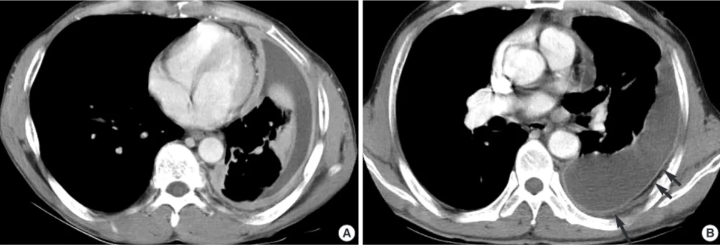 Fig. 1. (A) Initial chest computed tomography (CT) scan shows loculated pleural fluid, accumulated in nondependent portion, and marked circumferential pleural thickening on the left