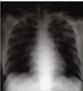 Fig. 2. Immediate  postoperative  chest  radiograph. 