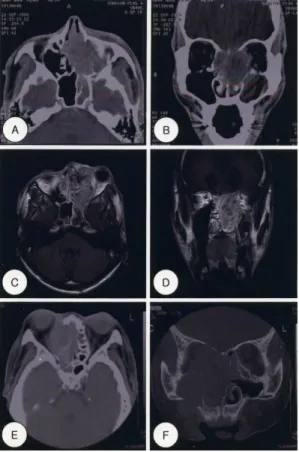 Fig. 1. Axial  and  coronal  views  of  paranasal  sinus  (PNS)  CT  scans  and  MRI.  A  and  B:  Axial  and  coronal  views  of  PNS  CT  scans  of  case  1  show  mass  lesion  originated  from  left  ethmoid  sinus