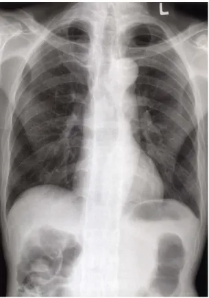 Fig. 2. In  resting  supine  position,  the  head  was  elevated  because  of  ankylosing  spondylitis.