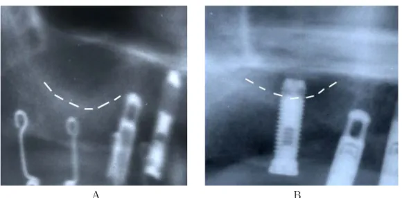 Fig. 1. Panoramic  radiographs.  A:  Radiograph  before  sinus  elevation  and  placement  of  implant