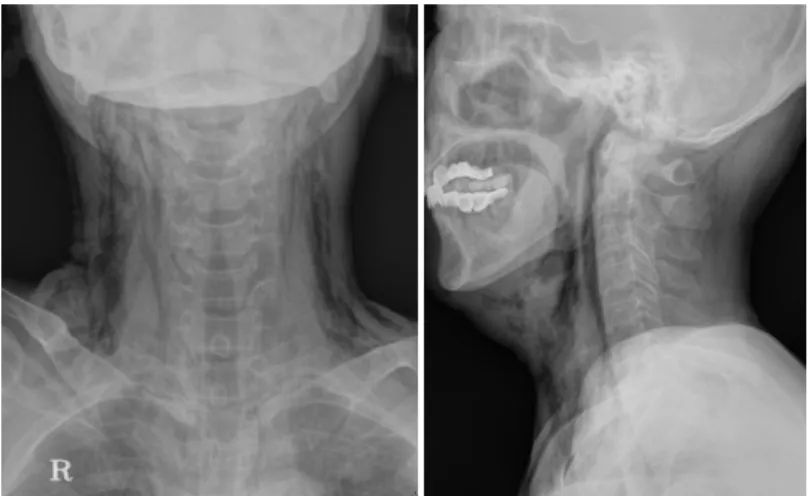Fig. 3. Neck  CT  views  showed  diffuse  emphysema  in  neck  soft  tissue  space  and  swelling  of  laryngeal  structures  due  to  laryngeal  trauma.