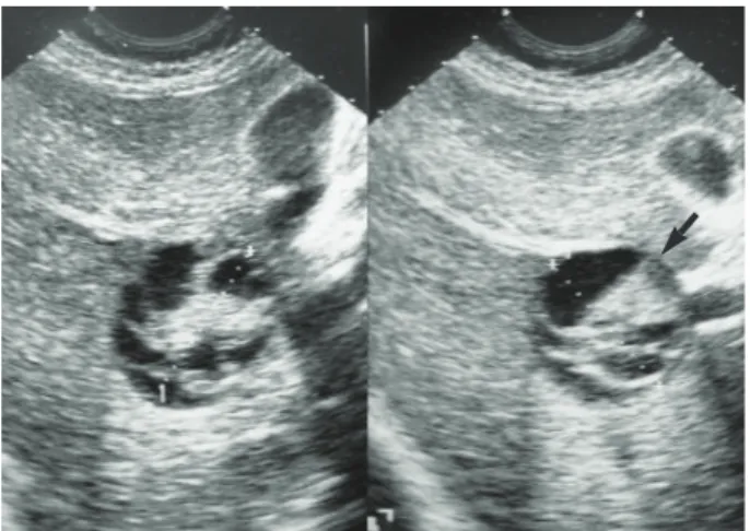 Fig. 1. Ultrasound findings of the mass. A 4.5-cm sized round hypoechoic mass with multiple central echogenic bands in the right lobe of the liver (segment V)