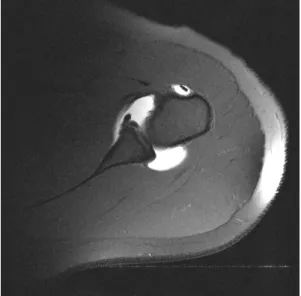 Fig. 2. MR  arthrogram  shows  a  typical  Bankart  lesion.
